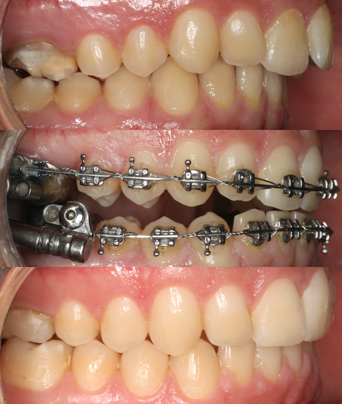 PROPULSORES MANDIBULARES