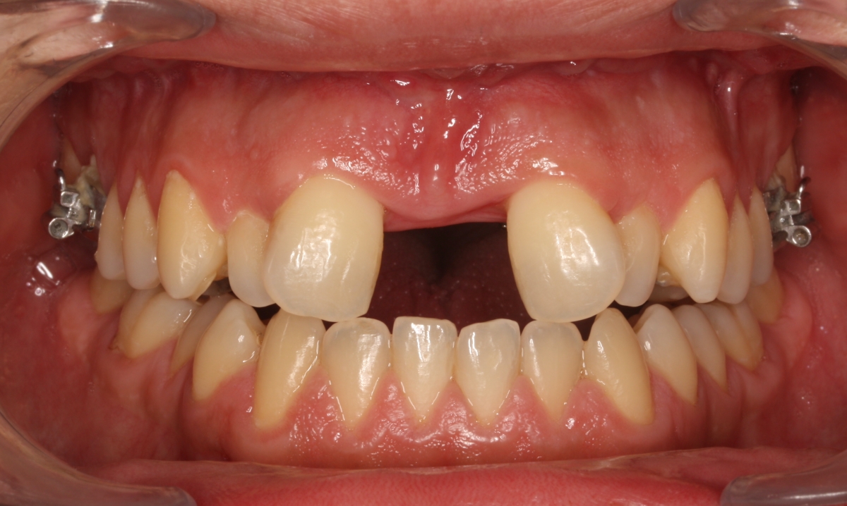 Expansão Rápida Assistida Cirurgicamente em adultos: SARPE