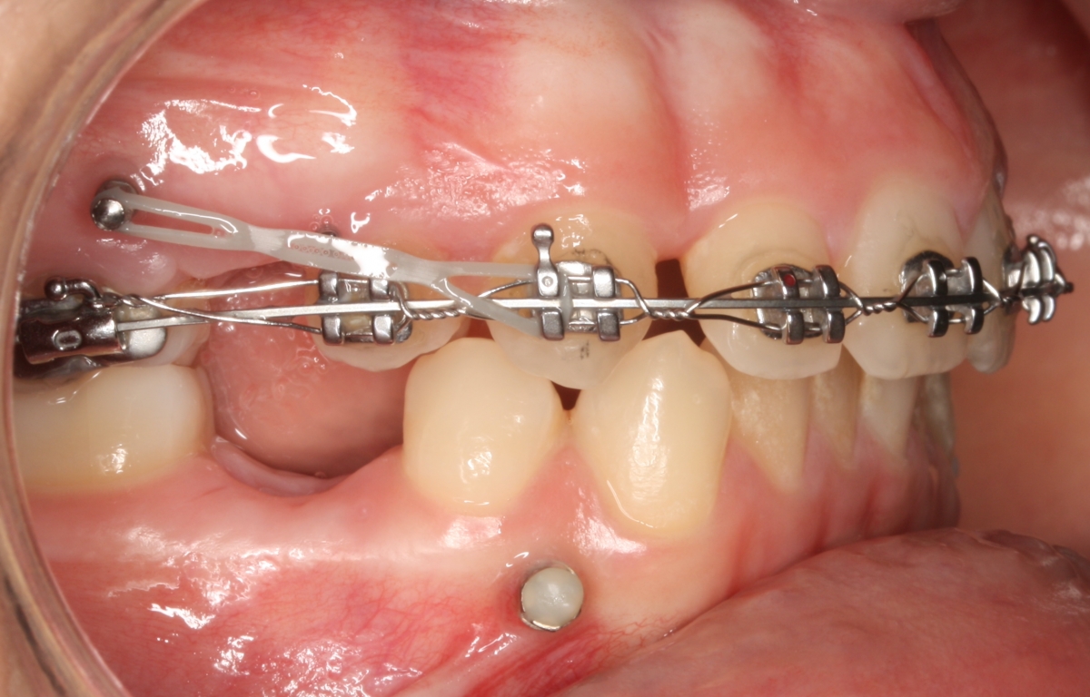 Microimplantes Interradiculares