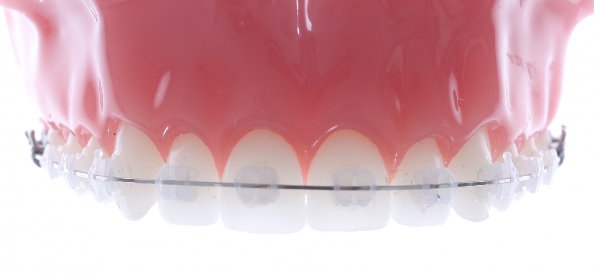 Afinal, Quanto custa um aparelho dentário?