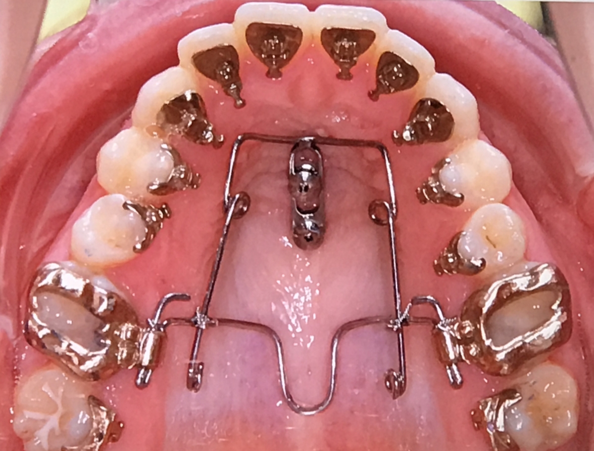 Ancoragem esquelética