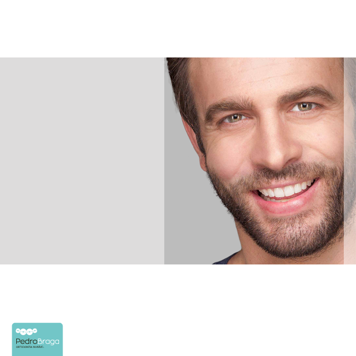 “Coloquei um aparelho dentário... e os dentes mexeram.”