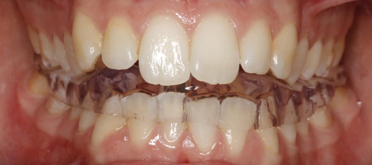 Problemas da Articulação Temporo- Mandibular