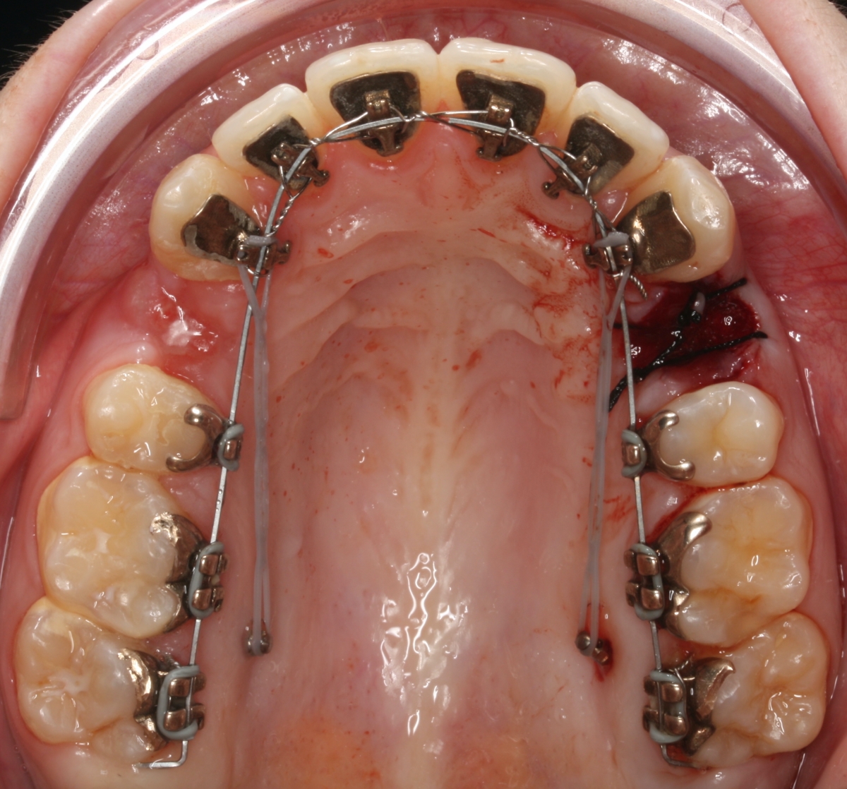 Ainda as extrações dentárias...