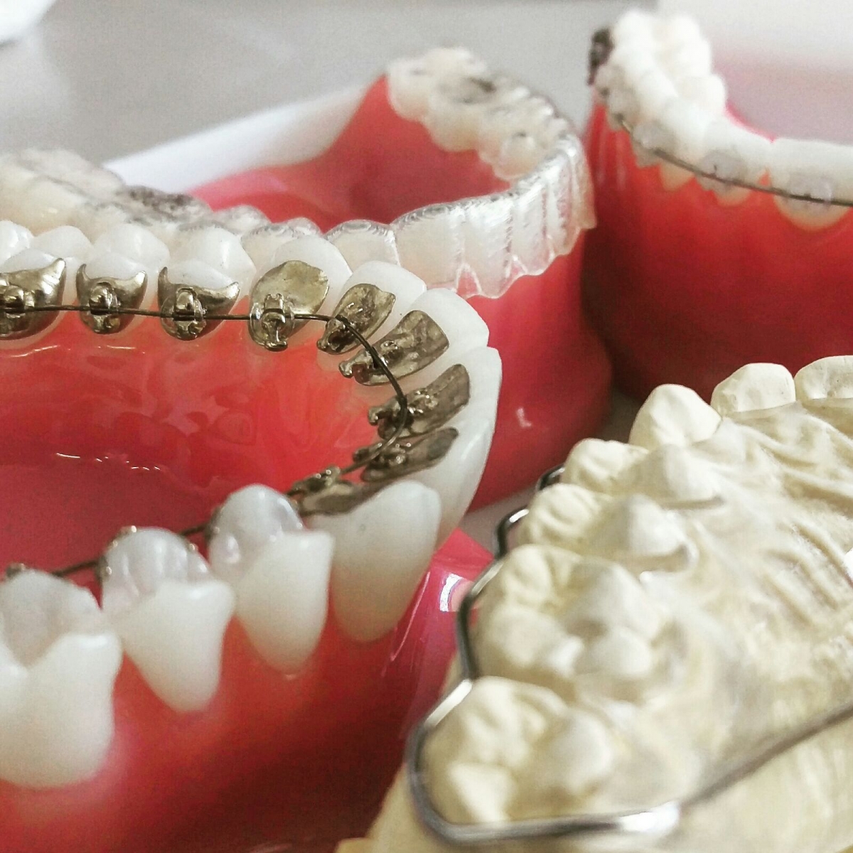 Que aparelho dentário escolher?