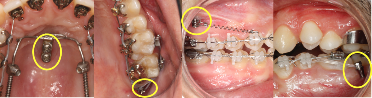 VANTAGENS DOS MICROIMPLANTES?