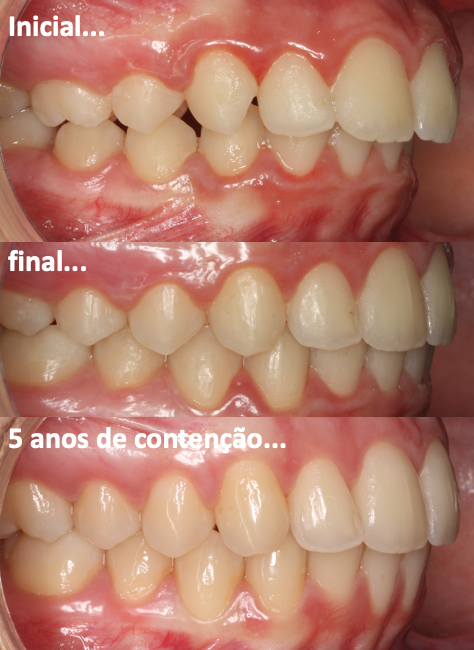 OS DENTES VOLTAM À SUA POSIÇÃO INICIAL?