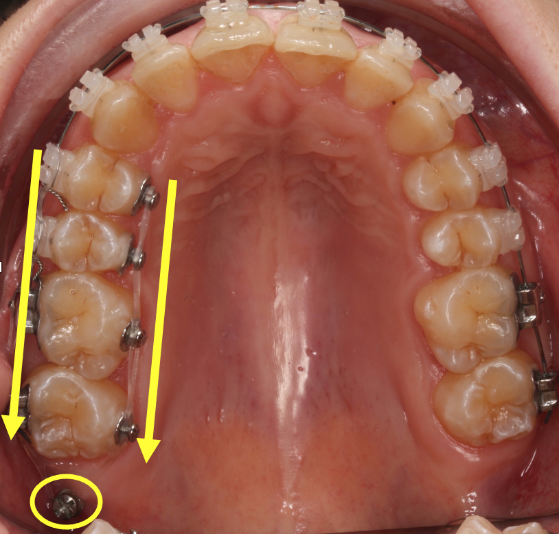 Microimplantes retromolares: O que são?