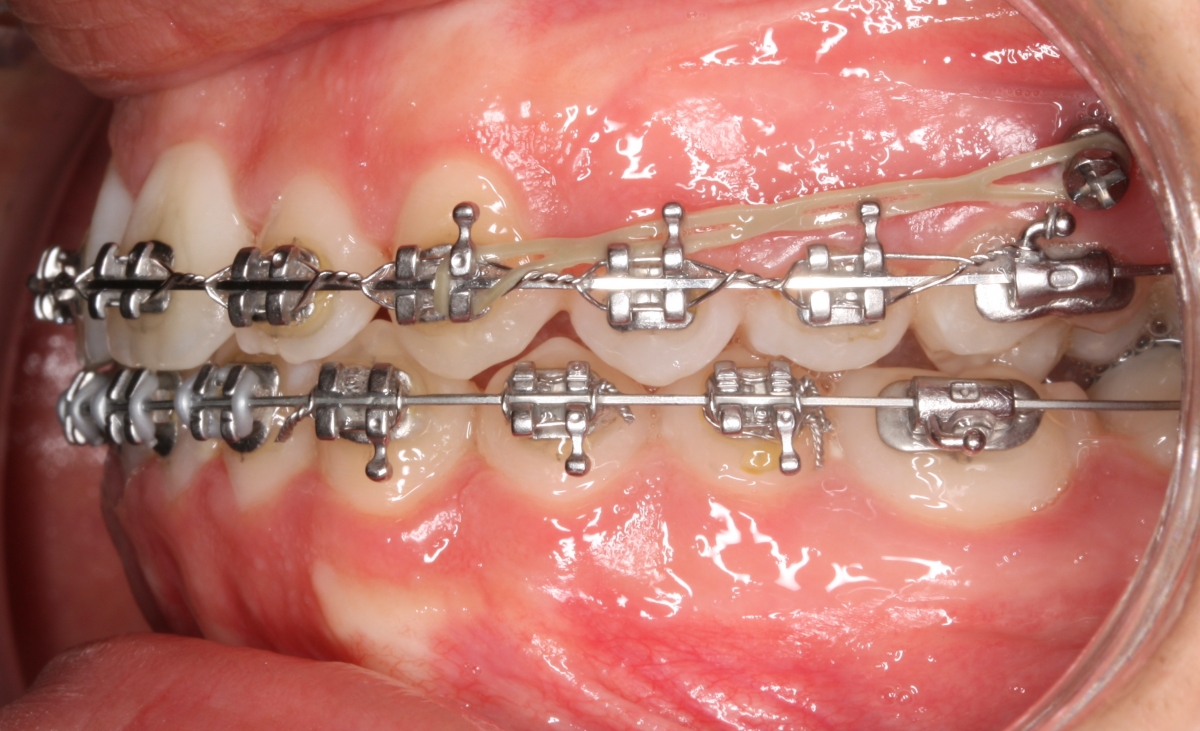 O que são Microimplantes Infrazigomáticos?