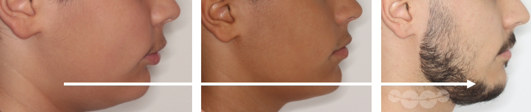 Aparelhos funcionais e estética da face