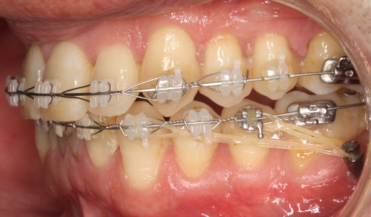 O que são Microimplantes Bucal-Shelf?